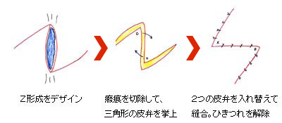 傷跡・キズアト・ケロイド・瘢痕（はんこん）の修正