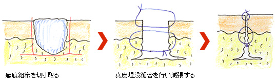 傷跡・キズアト・ケロイド・瘢痕（はんこん）の修正