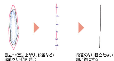 傷跡・キズアト・ケロイド・瘢痕（はんこん）の修正