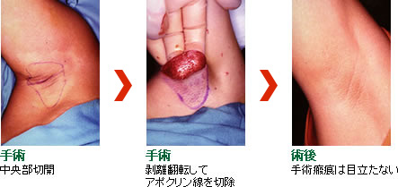 わきが・多汗症（腋臭症）の根治手術（保険適応）